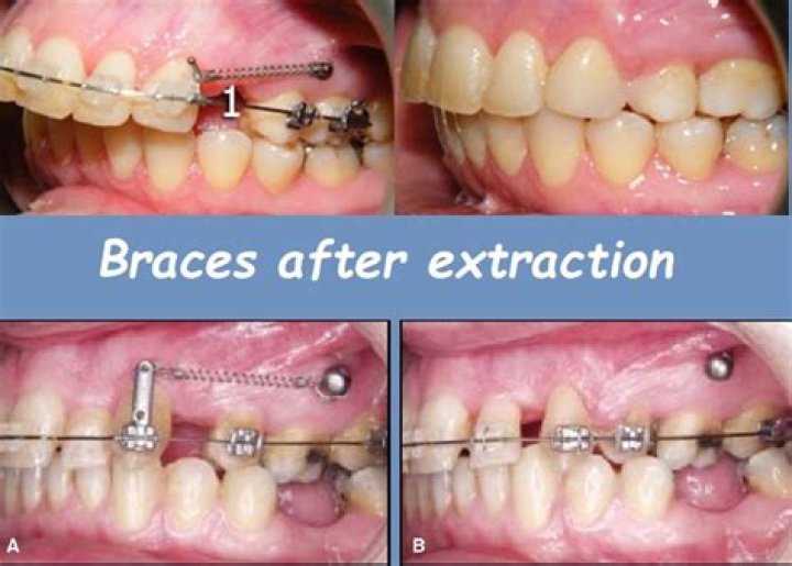 Are back teeth difficult to extract?
