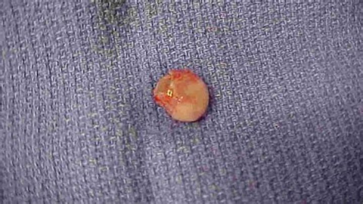 Are cysts hard?