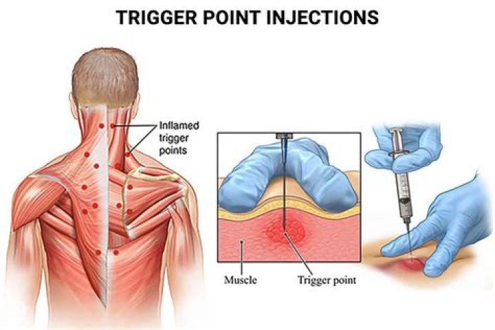 Are trigger point injections the same as nerve blocks?