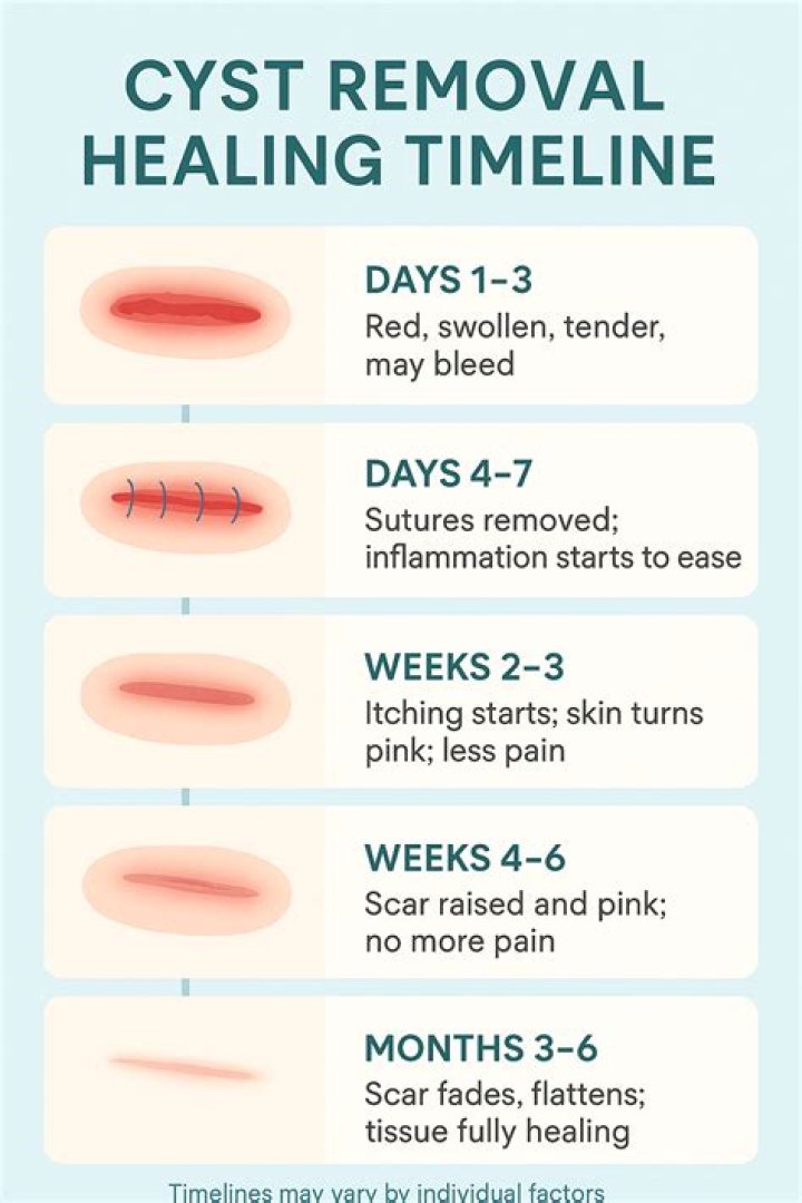 Are you put to sleep for cyst removal?