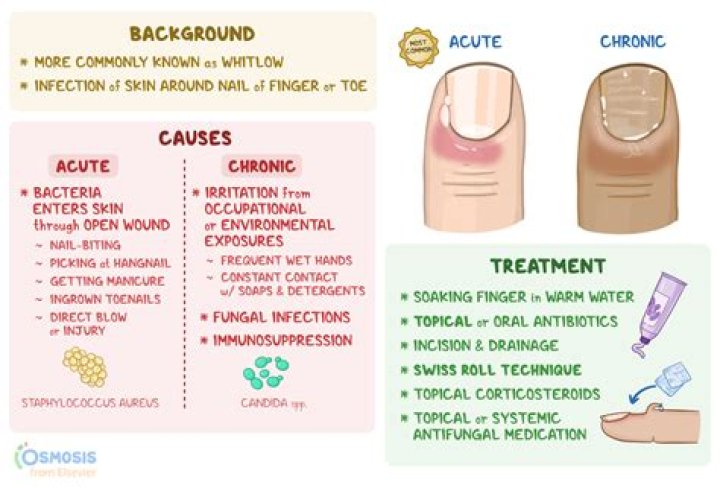 Can a felon get Obamacare?