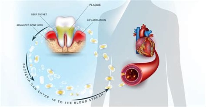 Can a tooth infection affect your whole body?
