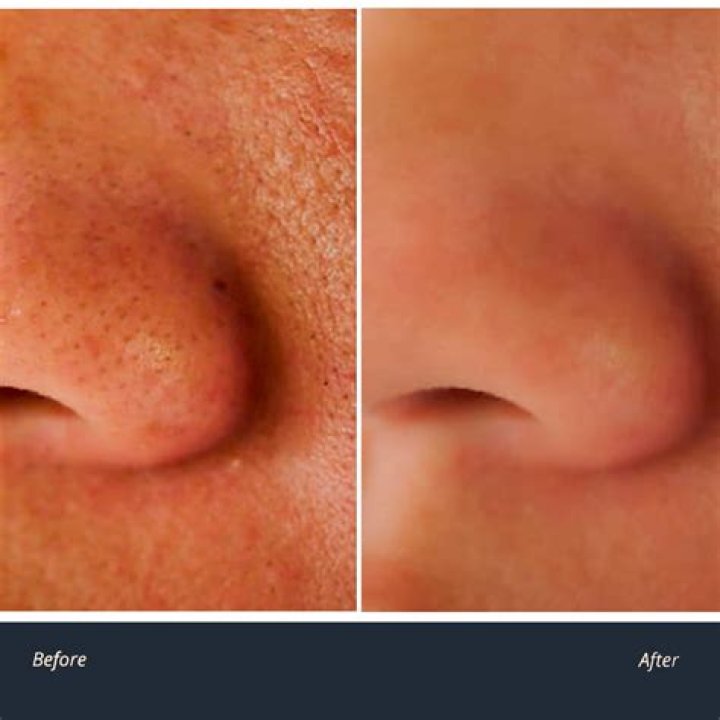 Can Colgate remove pores on face?