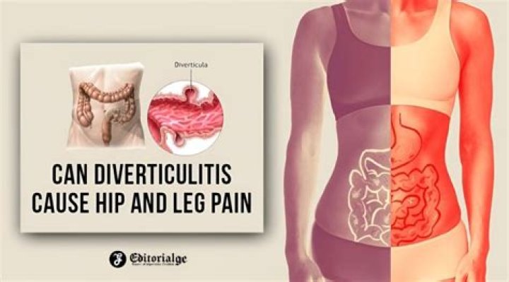 Can diverticulitis cause leg pain?