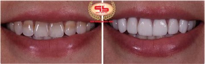 Can eroded enamel be restored?