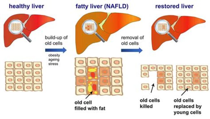 Can fatty liver Be Reversed?