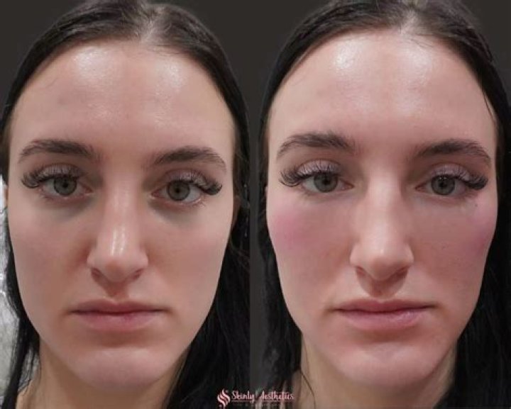 Can fillers help hooded eyes?