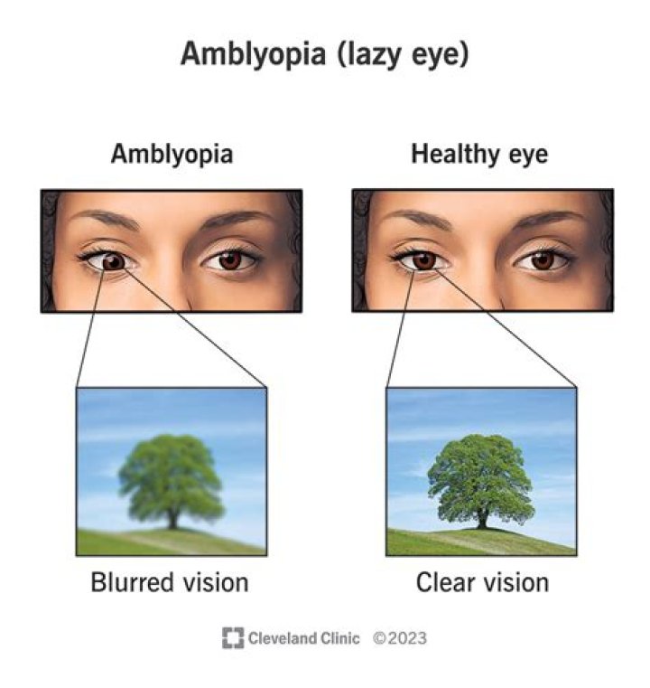 Can I get disability for amblyopia?