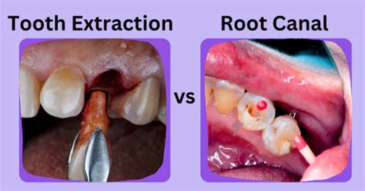 Can I have tooth removed rather than root canal?