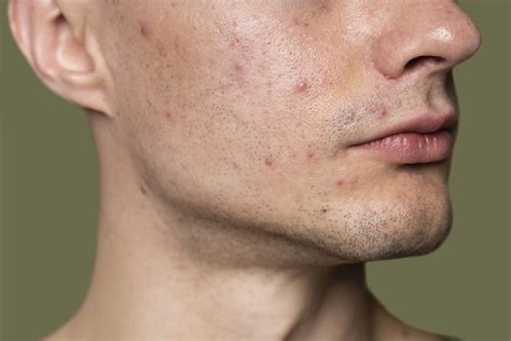 Can ice make acne worse?