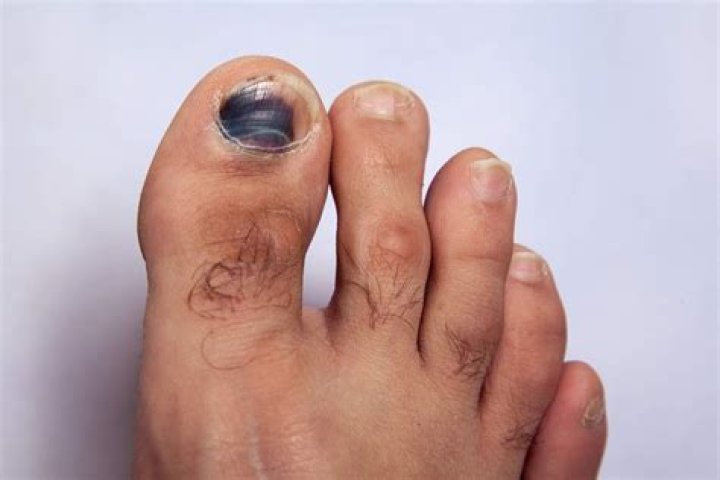 Can kidney disease cause black toenails?