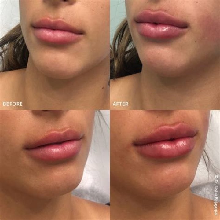 Can lip shape change?