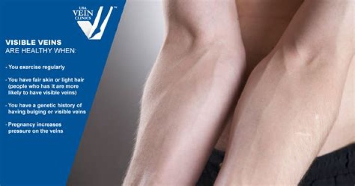 Can losing weight make veins more visible?