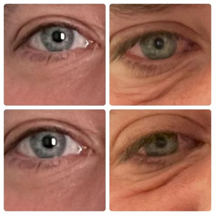 Can retinol cause permanent damage?