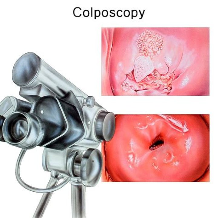 Can they numb you for a colposcopy?
