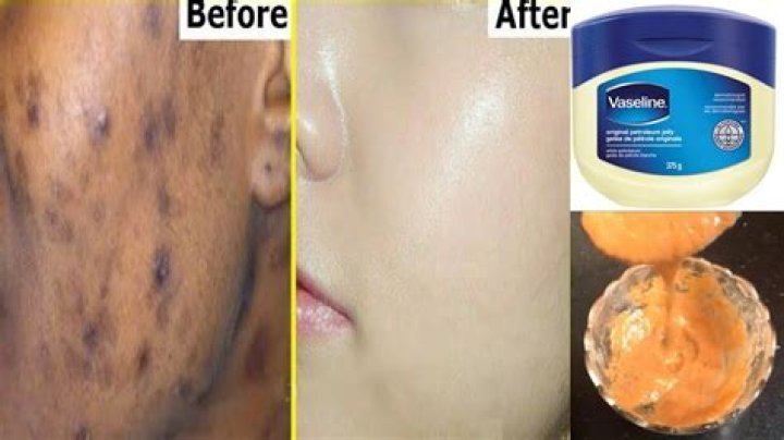 Can Vaseline remove dark spots?
