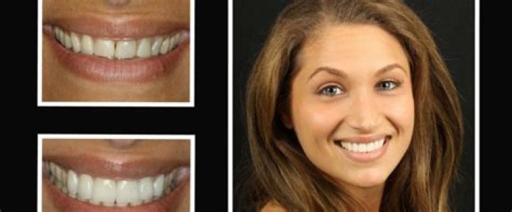 Can veneers last 30 years?