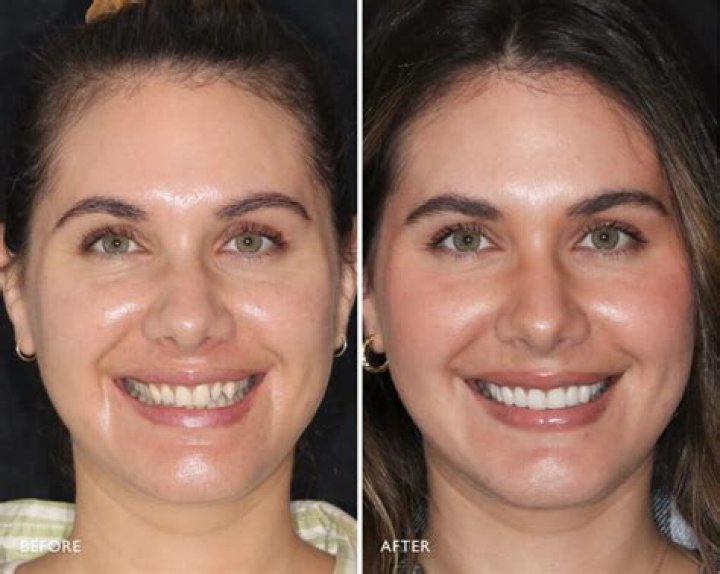 Can veneers make your face look longer?
