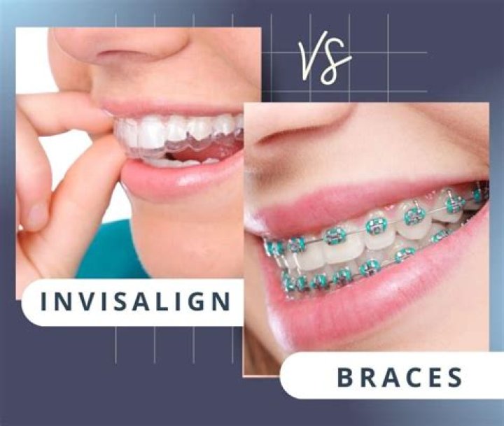 Can you do Invisalign twice?