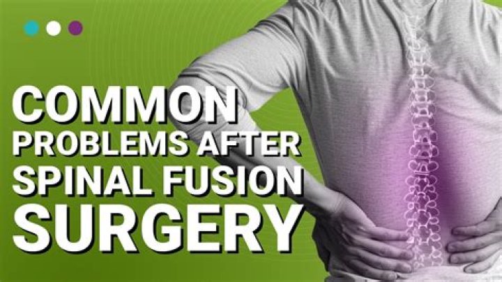 Can you feel the hardware after spinal fusion?