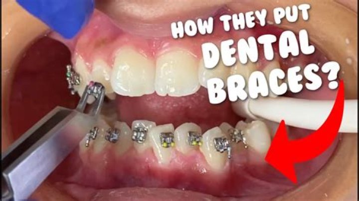 Can you get braces for one tooth?