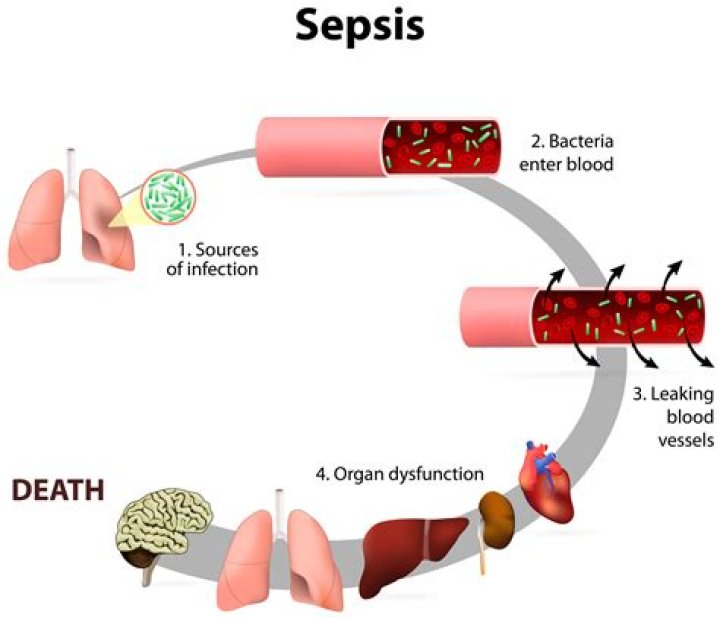 Can you get sepsis from E. coli?