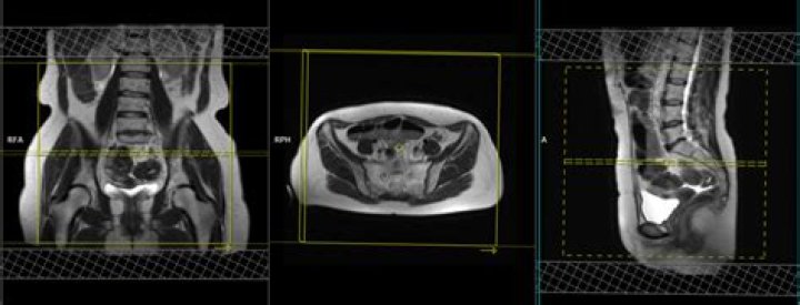 Can you see endometriosis on pelvic MRI?