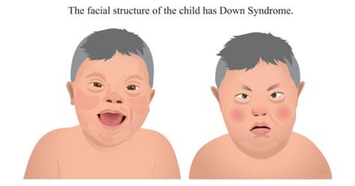 Do babies with Down syndrome have a lower birth weight?