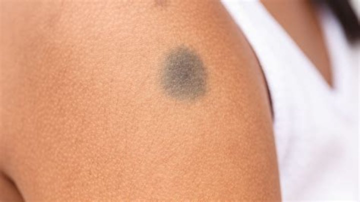 Do birthmarks go away?