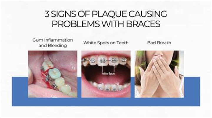 Do braces cause long term problems?