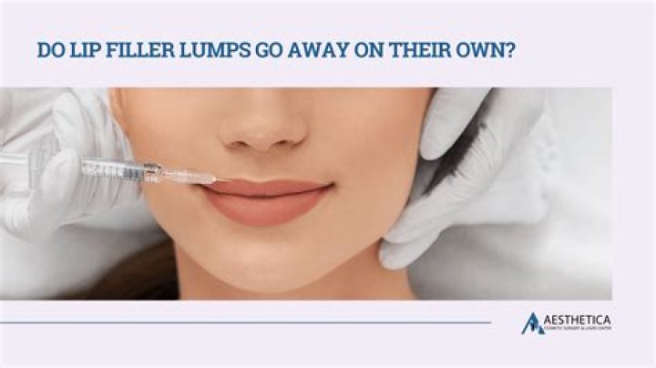 Do lip filler lumps go away?