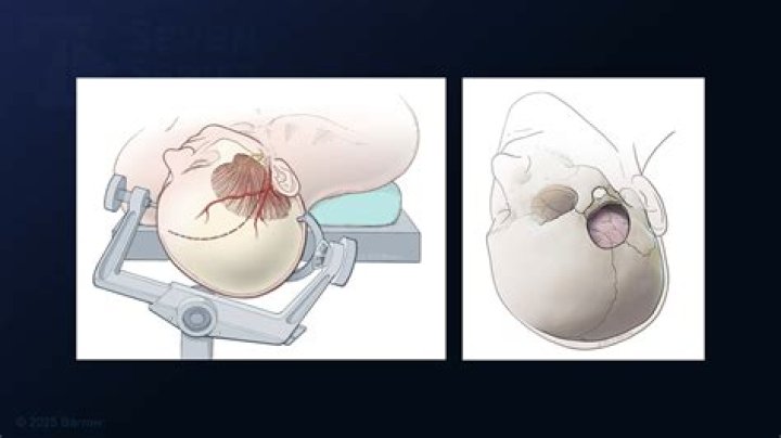 Do you go to ICU after craniotomy?
