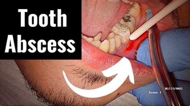 Does a tooth abscess bleed?
