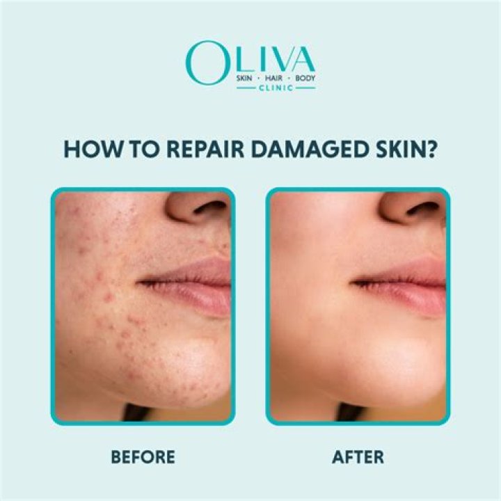 Does Aloe Vera repair damaged skin?