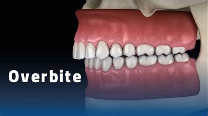 Does an overbite make your chin stick out?