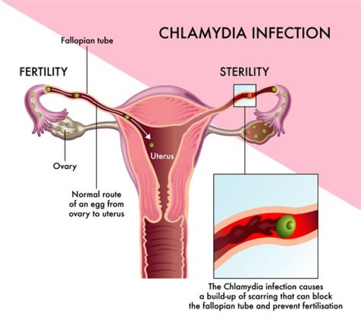 Does chlamydia feel like a yeast infection?