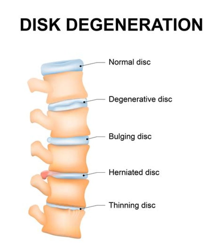 Does degenerative disc disease show on MRI?