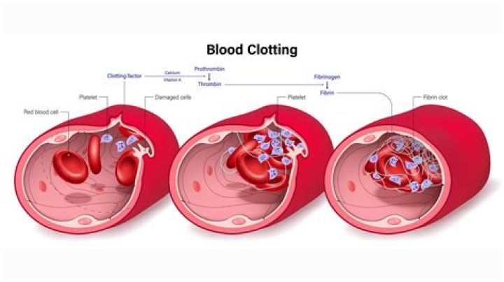Does elevation affect blood clots?