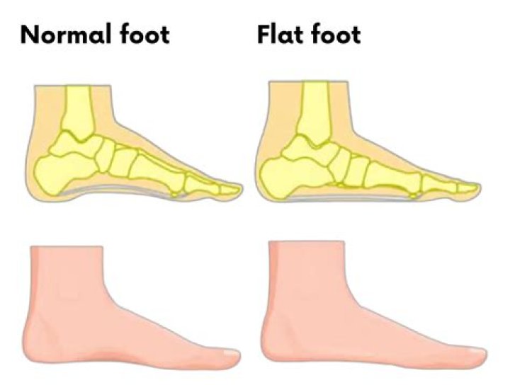 Does flat feet make you slower?