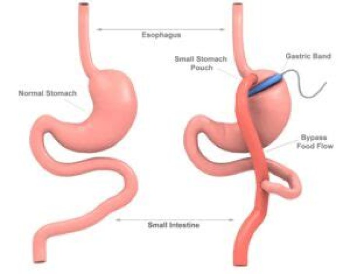 Does gastric bypass shorten life span?