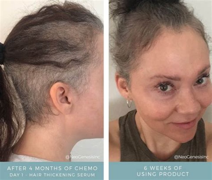 Does hair grow back GREY after chemo?
