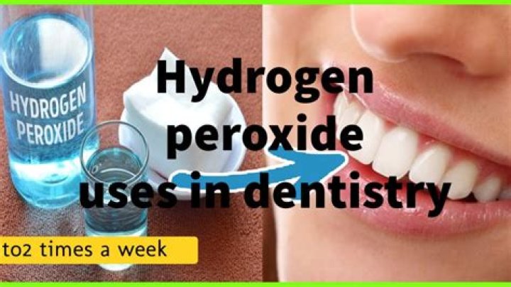 Does hydrogen peroxide help with tonsil stones?