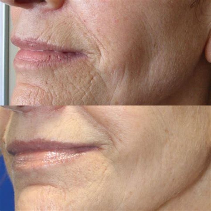 Does microneedling have long term effects?