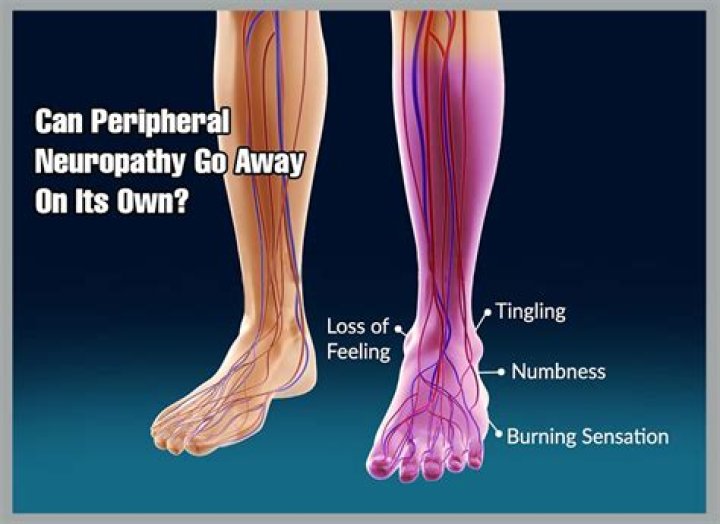 Does neuropathy go away?
