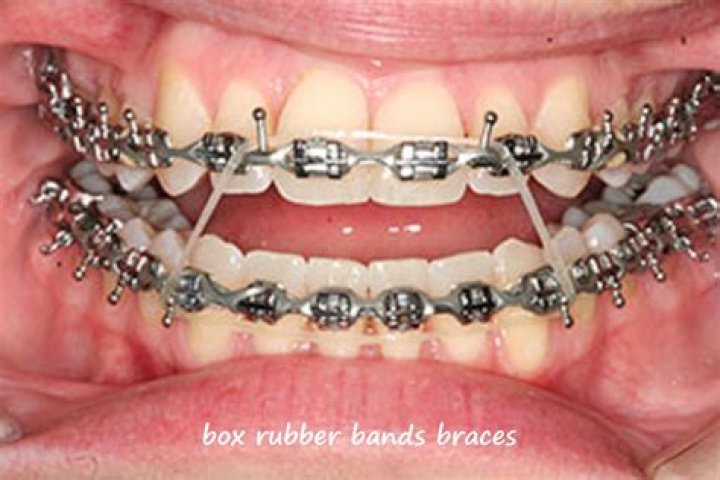 Does rubber bands mean braces are almost done?