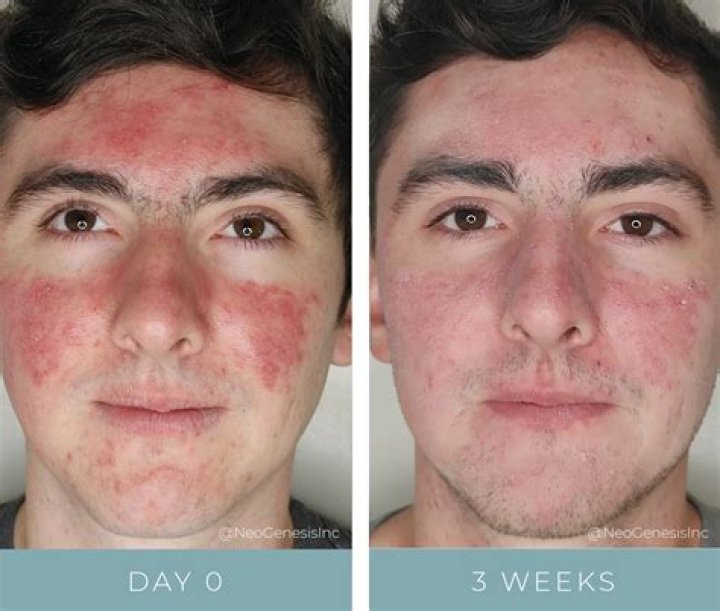 Does salicylic acid make acne worse before it gets better?