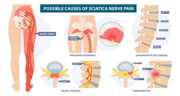 Does sciatica cause groin pain?