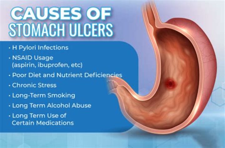 Does stomach ulcers cause leg pain?