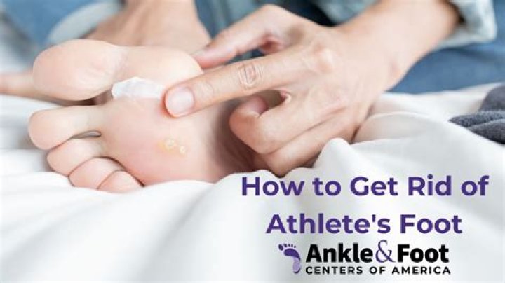 Does vinegar help athletes foot?