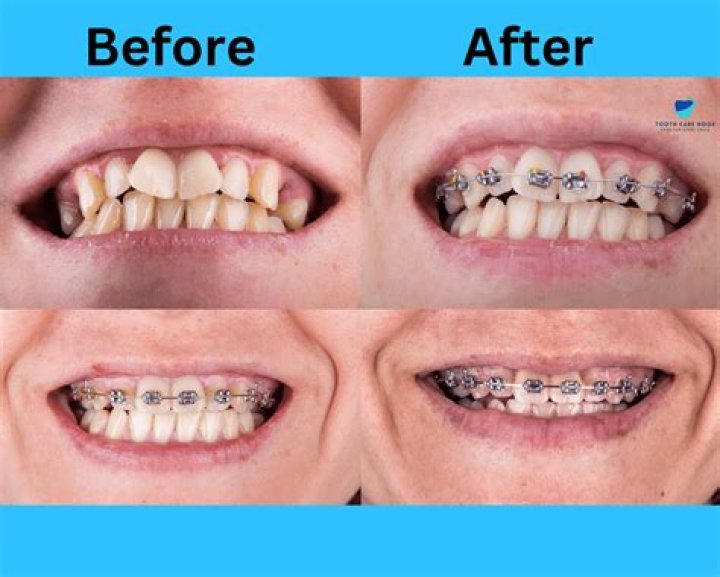 How can I fix my teeth naturally?